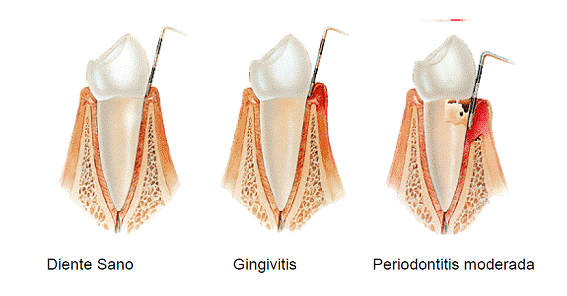 Porphyromonas gingivalis - Wikipedia